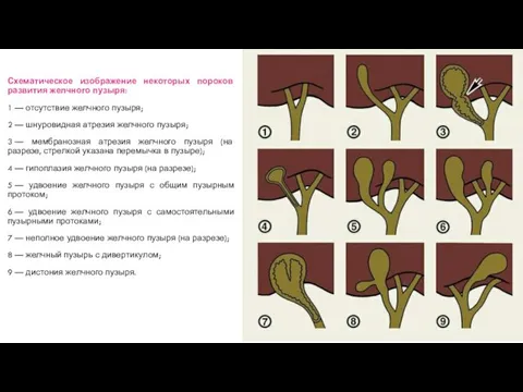 Схематическое изображение некоторых пороков развития желчного пузыря: 1 — отсутствие желчного