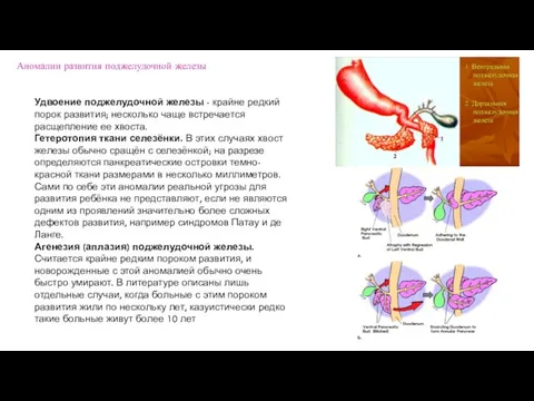 Аномалии развития поджелудочной железы Удвоение поджелудочной железы - крайне редкий порок