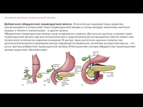 Добавочная (аберрантная) поджелудочная железа. Относительно нередкий порок развития, заключающийся в гетеротопии