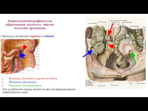 Recessus ileocecalis superior et inferior Recessus retrocecalis Recessus intersigmoideus Эти углубления