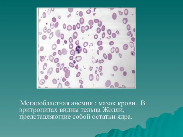 Мегалобластная анемия : мазок крови. В эритроцитах видны тельца Жолли, представляющие собой остатки ядра.