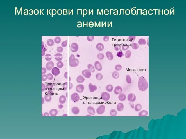 Мазок крови при мегалобластной анемии