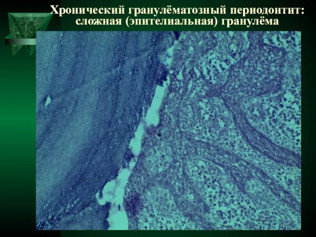 Хронический гранулёматозный периодонтит: сложная (эпителиальная) гранулёма