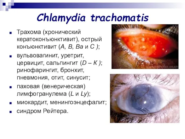 Chlamydia trachomatis Трахома (хронический кератоконъюнктивит), острый конъюнктивит (А, В, Ва и