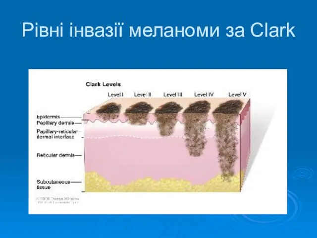 Рівні інвазії меланоми за Clark