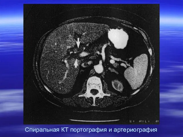 Спиральная КТ портография и артериография