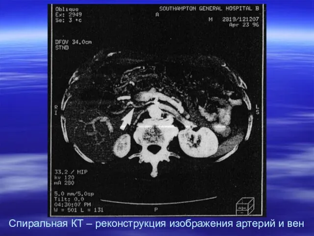 Спиральная КТ – реконструкция изображения артерий и вен