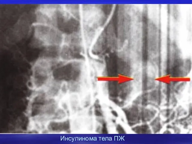 Инсулинома тела ПЖ