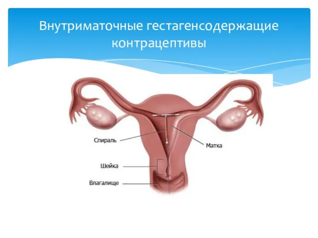 Внутриматочные гестагенсодержащие контрацептивы