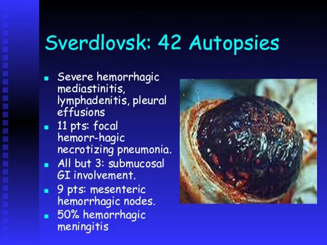 Sverdlovsk: 42 Autopsies Severe hemorrhagic mediastinitis, lymphadenitis, pleural effusions 11 pts: