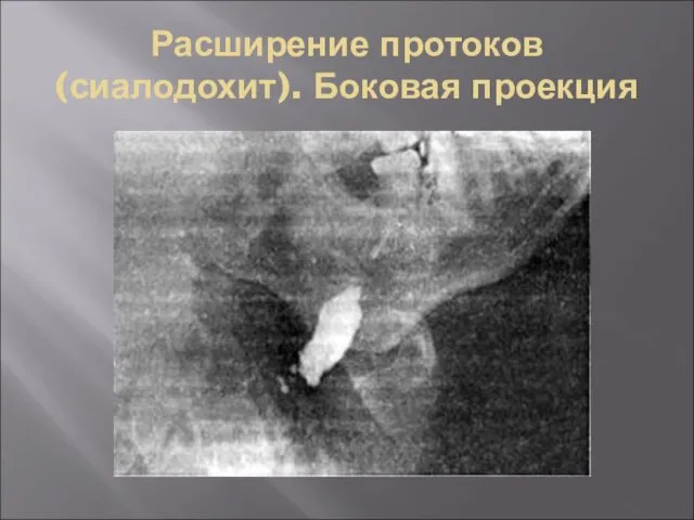 Расширение протоков (сиалодохит). Боковая проекция