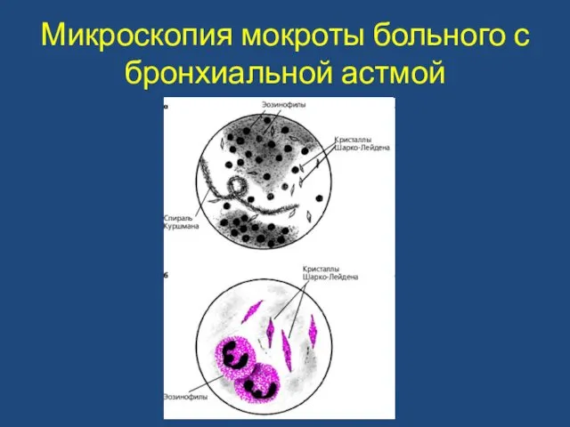 Микроскопия мокроты больного с бронхиальной астмой