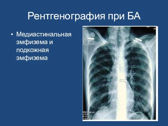 Рентгенография при БА Медиастинальная эмфизема и подкожная эмфизема