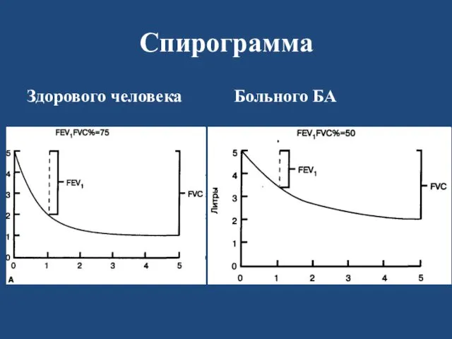 Спирограмма Здорового человека Больного БА