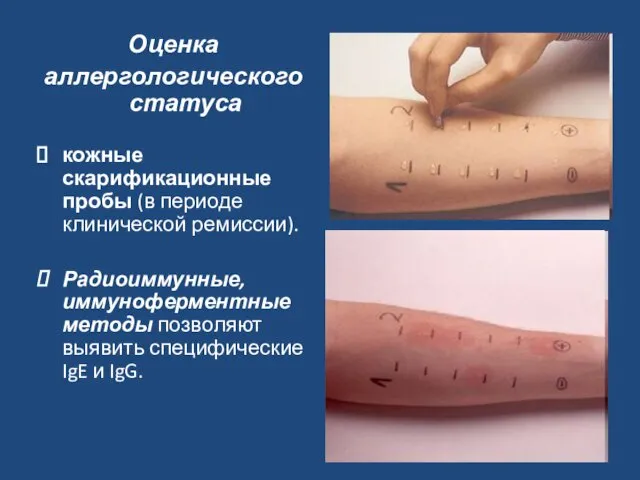 Оценка аллергологического статуса кожные скарификационные пробы (в периоде клинической ремиссии). Радиоиммунные,