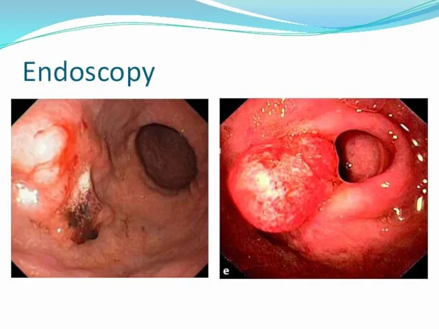 Endoscopy