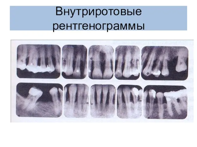 Внутриротовые рентгенограммы