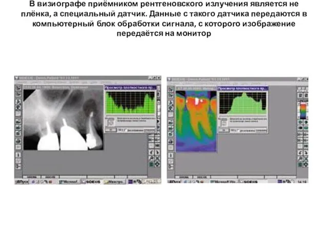 В визиографе приёмником рентгеновского излучения является не плёнка, а специальный датчик.