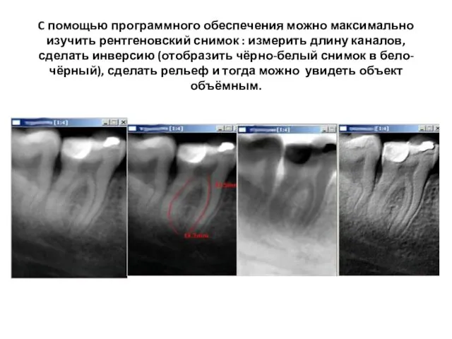 C помощью программного обеспечения можно максимально изучить рентгеновский снимок : измерить