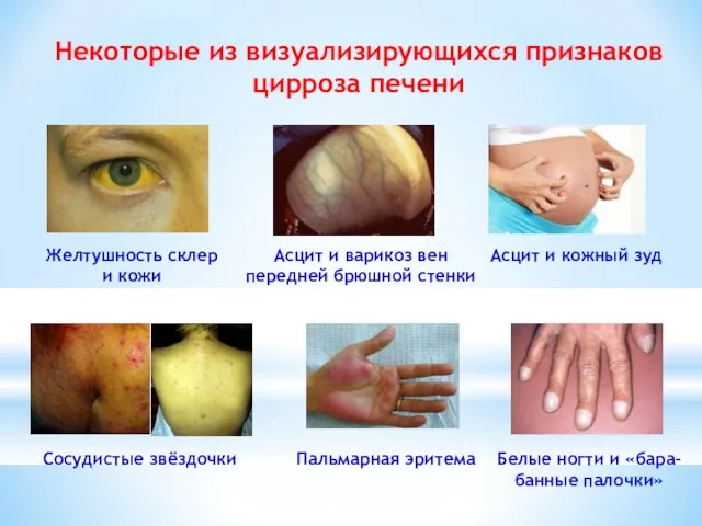 Некоторые из визуализирующихся признаков цирроза печени Желтушность склер и кожи Пальмарная