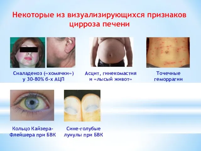 Некоторые из визуализирующихся признаков цирроза печени Асцит, гинекомастия и «лысый живот»