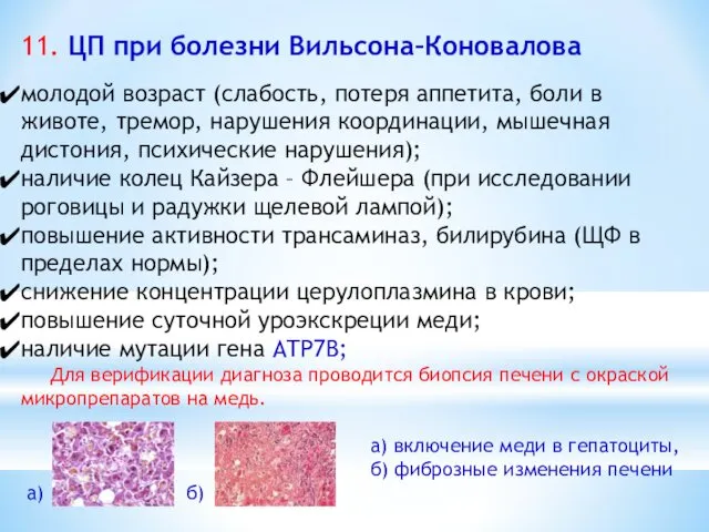 11. ЦП при болезни Вильсона–Коновалова молодой возраст (слабость, потеря аппетита, боли