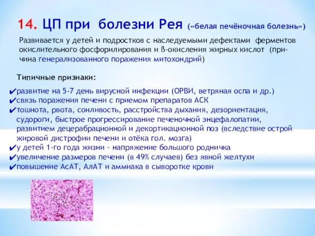 14. ЦП при болезни Рея («белая печёночная болезнь») Типичные признаки: развитие