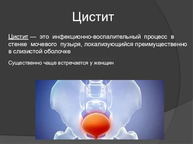 Цистит Цистит — это инфекционно-воспалительный процесс в стенке мочевого пузыря, локализующийся