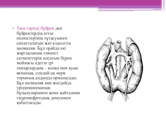 Таға тәрізді бүйрек деп бүйректердің аттас полюстерінің тұтасуымен сипатталатын жиі кздесетін