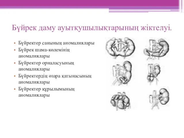 Бүйрек даму ауытқушылықтарының жіктелуі. Бүйректер санының аномалиялары Бүйрек шама-көлемінің аномалиялары Бүйректер