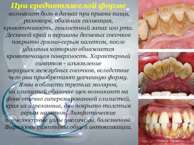 При среднетяжелой форме возникает боль в деснах при приеме пищи, разговоре,