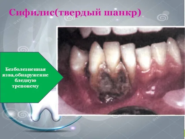 Сифилис(твердый шанкр) Безболезненная язва,обнаружение бледную трепонему