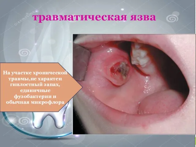 травматическая язва На участке хронической травмы,не характен гнилостный запах,единичные фузобактерии и обычная микрофлора