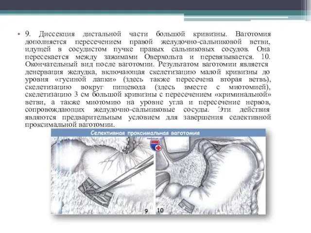 9. Диссекция дистальной части большой кривизны. Ваготомия дополняется пересечением правой желудочно-сальниковой