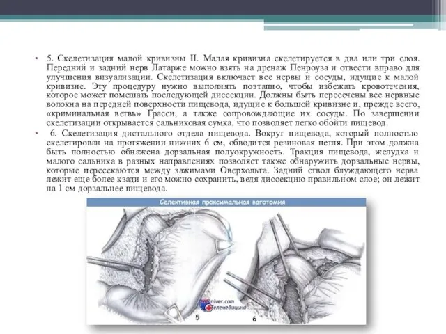 5. Скелетизация малой кривизны II. Малая кривизна скелетируется в два или