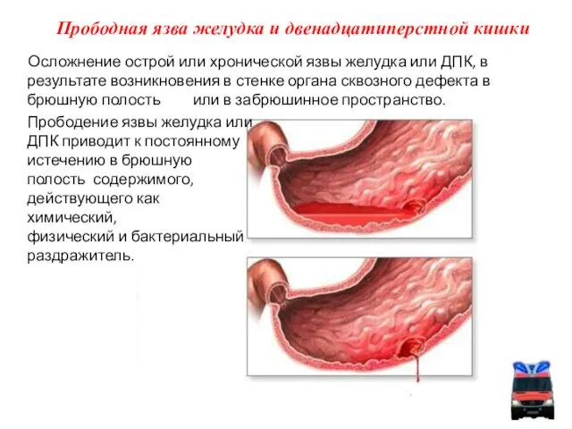 Прободная язва желудка и двенадцатиперстной кишки Осложнение острой или хронической язвы