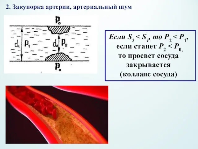 2. Закупорка артерии, артериальный шум Если S2 если станет Р2 то просвет сосуда закрывается (коллапс сосуда)