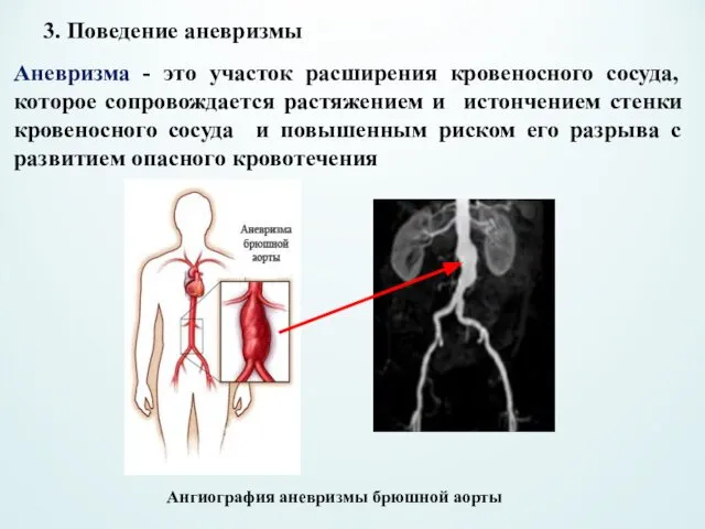 3. Поведение аневризмы Аневризма - это участок расширения кровеносного сосуда, которое