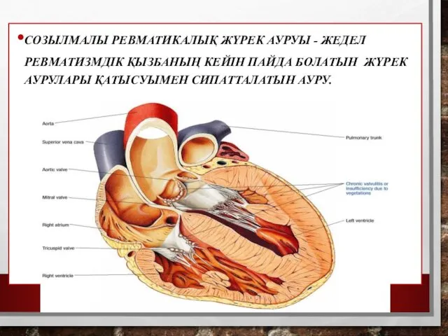 СОЗЫЛМАЛЫ РЕВМАТИКАЛЫҚ ЖҮРЕК АУРУЫ - ЖЕДЕЛ РЕВМАТИЗМДІК ҚЫЗБАНЫҢ КЕЙІН ПАЙДА БОЛАТЫН ЖҮРЕК АУРУЛАРЫ ҚАТЫСУЫМЕН СИПАТТАЛАТЫН АУРУ.