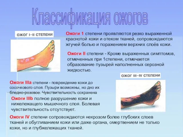 Ожоги 1 степени проявляются резко выраженной краснотой кожи и отеком тканей,