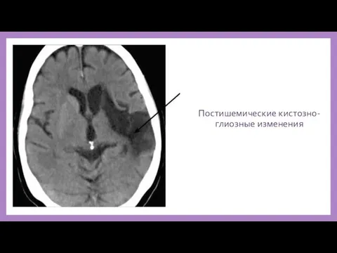 Постишемические кистозно-глиозные изменения