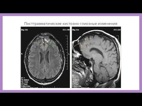 Посттравматические кистозно-глиозные изменения