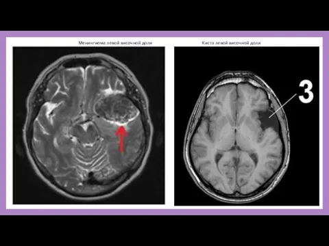 Менингиома левой височной доли Киста левой височной доли
