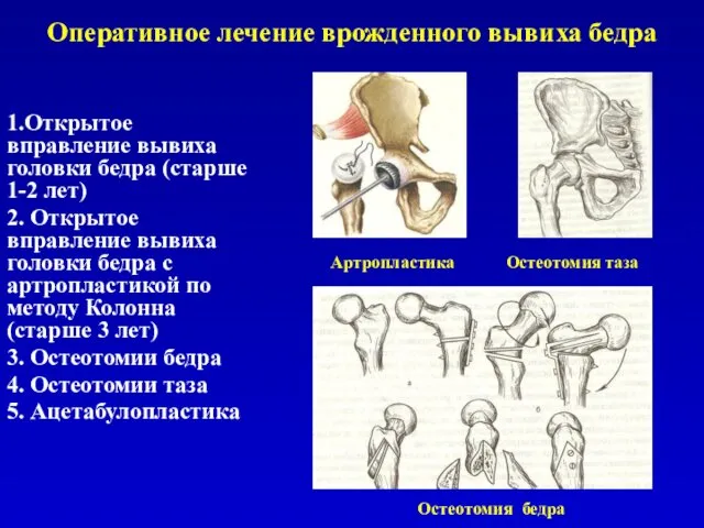 Оперативное лечение врожденного вывиха бедра 1.Открытое вправление вывиха головки бедра (старше