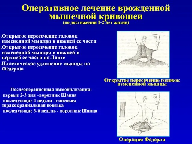 Оперативное лечение врожденной мышечной кривошеи (по достижении 1-2 лет жизни) Открытое