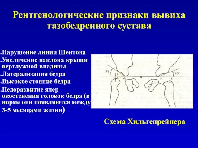 Рентгенологические признаки вывиха тазобедренного сустава Нарушение линии Шентона Увеличение наклона крыши