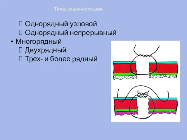 Типы кишечного шва Однорядный узловой Однорядный непрерывный Многорядный Двухрядный Трех- и более рядный