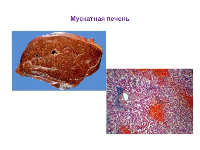 Мускатная печень