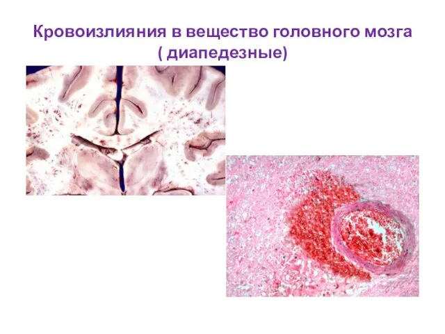 Кровоизлияния в вещество головного мозга ( диапедезные)