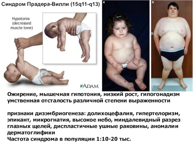 Ожирение, мышечная гипотония, низкий рост, гипогонадизм умственная отсталость различной степени выраженности